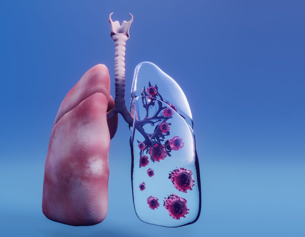Les tumeurs broncho-pulmonaires
