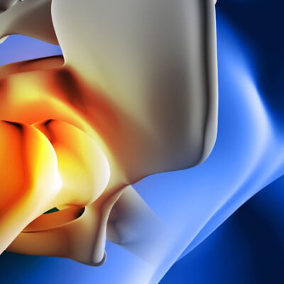 Les différentes techniques de chirurgie de la hanche expliquées